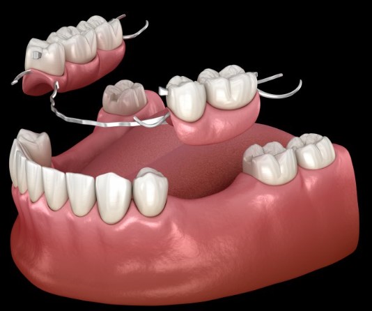 Denture Care 101, denture hygiene, prosthesis maintenance, oral appliance care, dental appliance cleaning, denture wellness, oral prosthesis upkeep, dental appliance hygiene, dentition preservation, dental restoration guidance, oral health tips, mouth appliance maintenance, denture cleansing, oral wellbeing practices, dental appliance management, denture cleaning routine, oral health care, mouthpiece maintenance, dental prosthesis care, denture handling tips, dental material maintenance, oral appliance hygiene, denture maintenance techniques, oral appliance cleanliness, dental hygiene for dentures